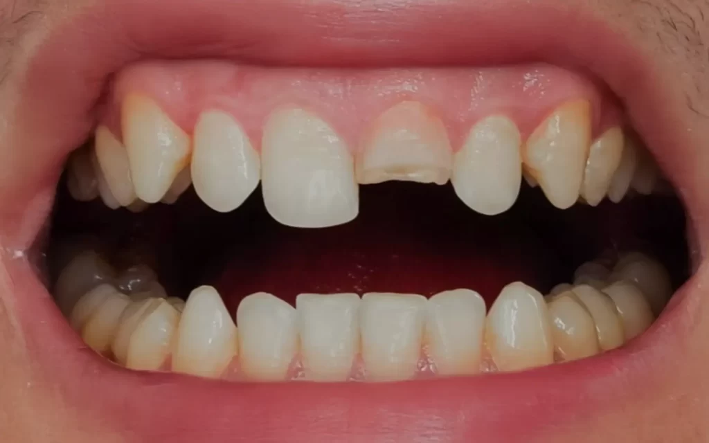 A close up image of injured teeth after a sporting incident
