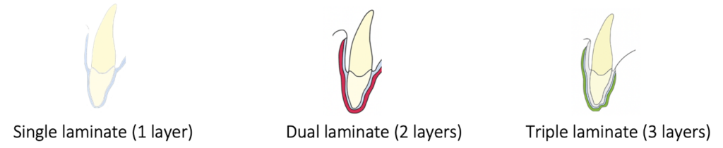 Different Layers of Dental Made mouthguards